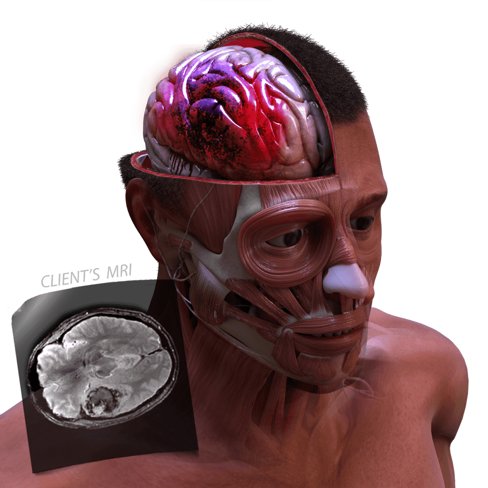 brain injury