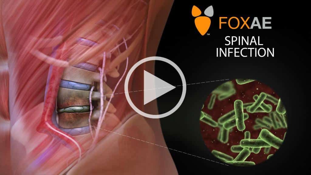 spinal infection