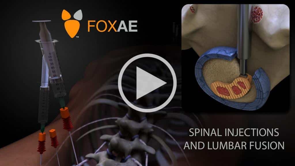 sur - spinal injections and lumbar fusion