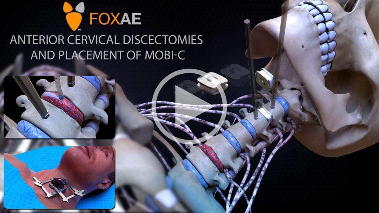 anterior cervical discectomies and placement of mobi-C