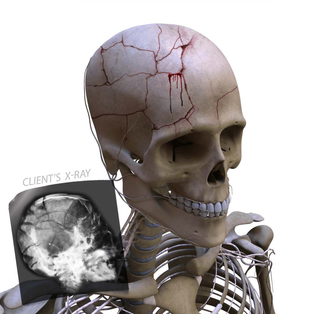 bone crack skull