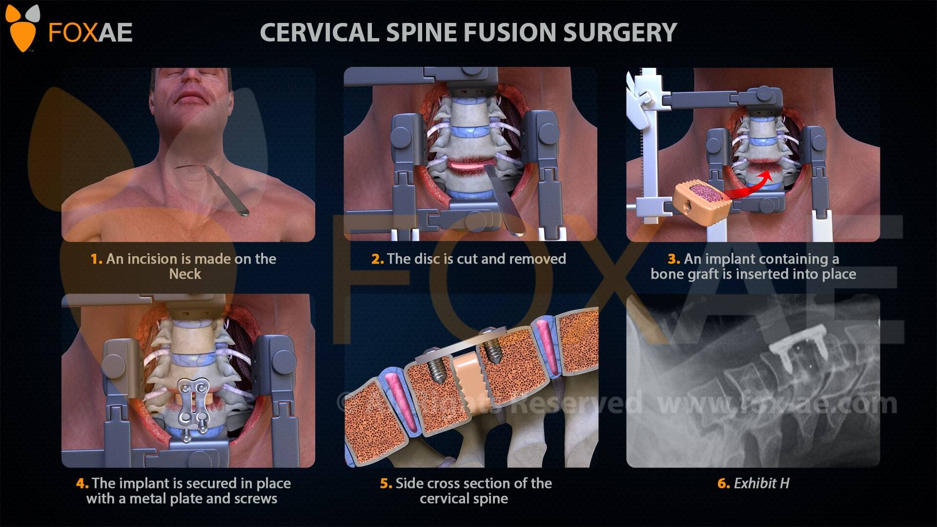 cervical spine fusion surgery