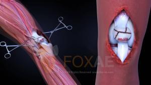 internal fixation right patella fracture