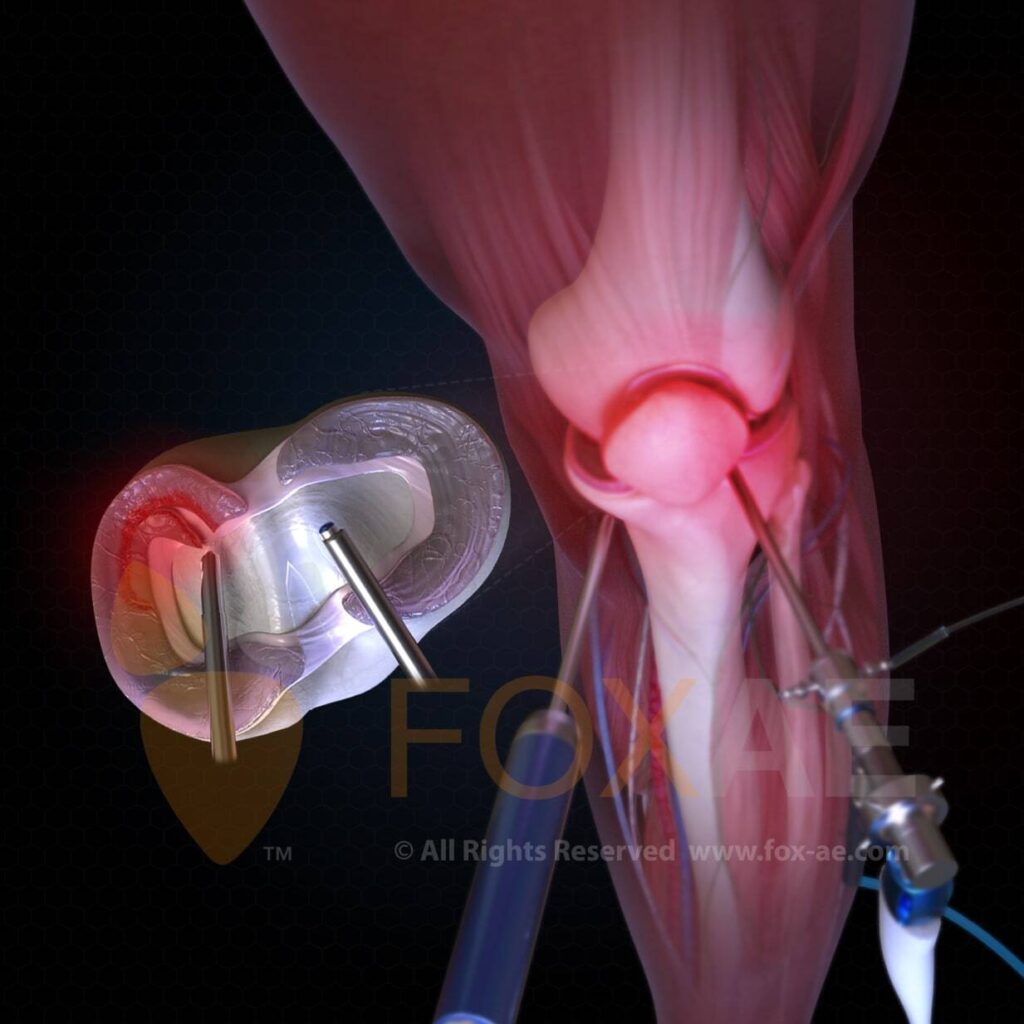 knee arthroscopy