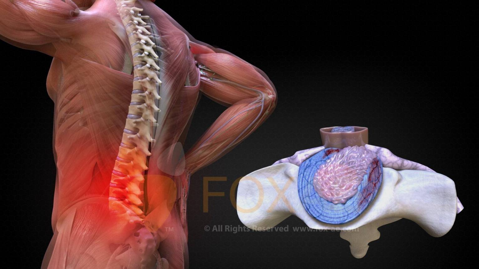 Cauda Equina Syndrome Why Misdiagnosis Is Dangerous
