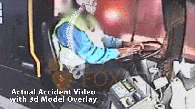 spinal injuries accident animation