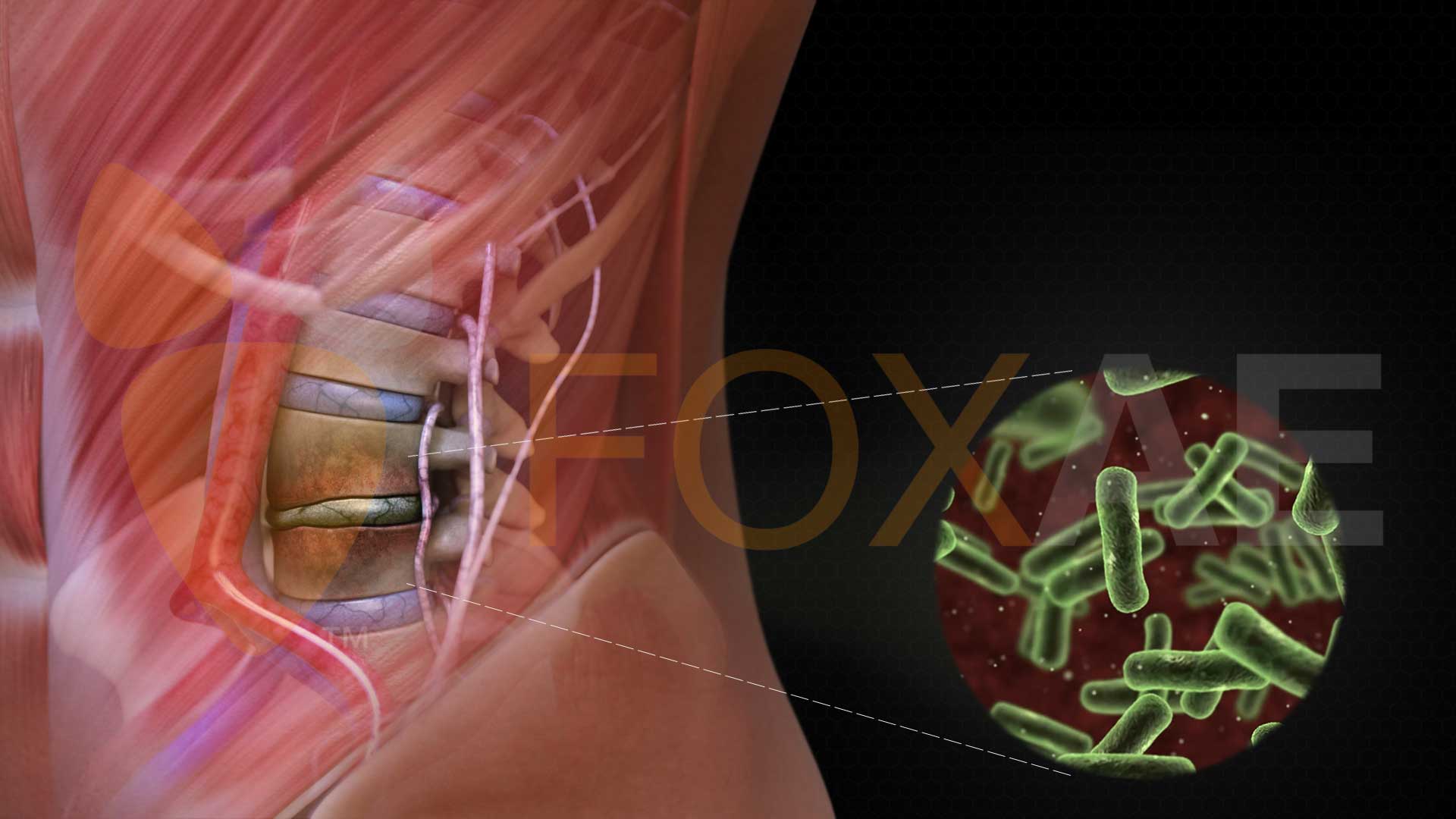 Spinal_Infection