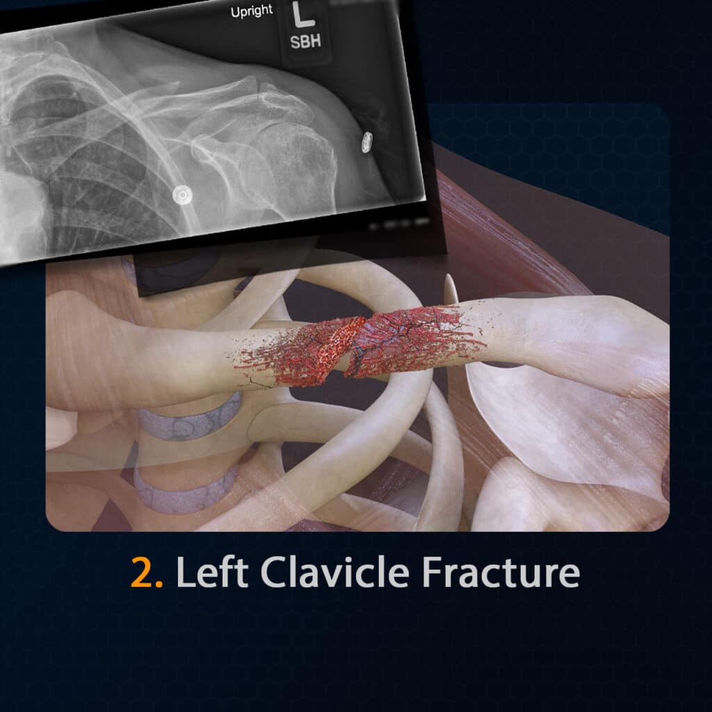 Vehicle Accident clavical