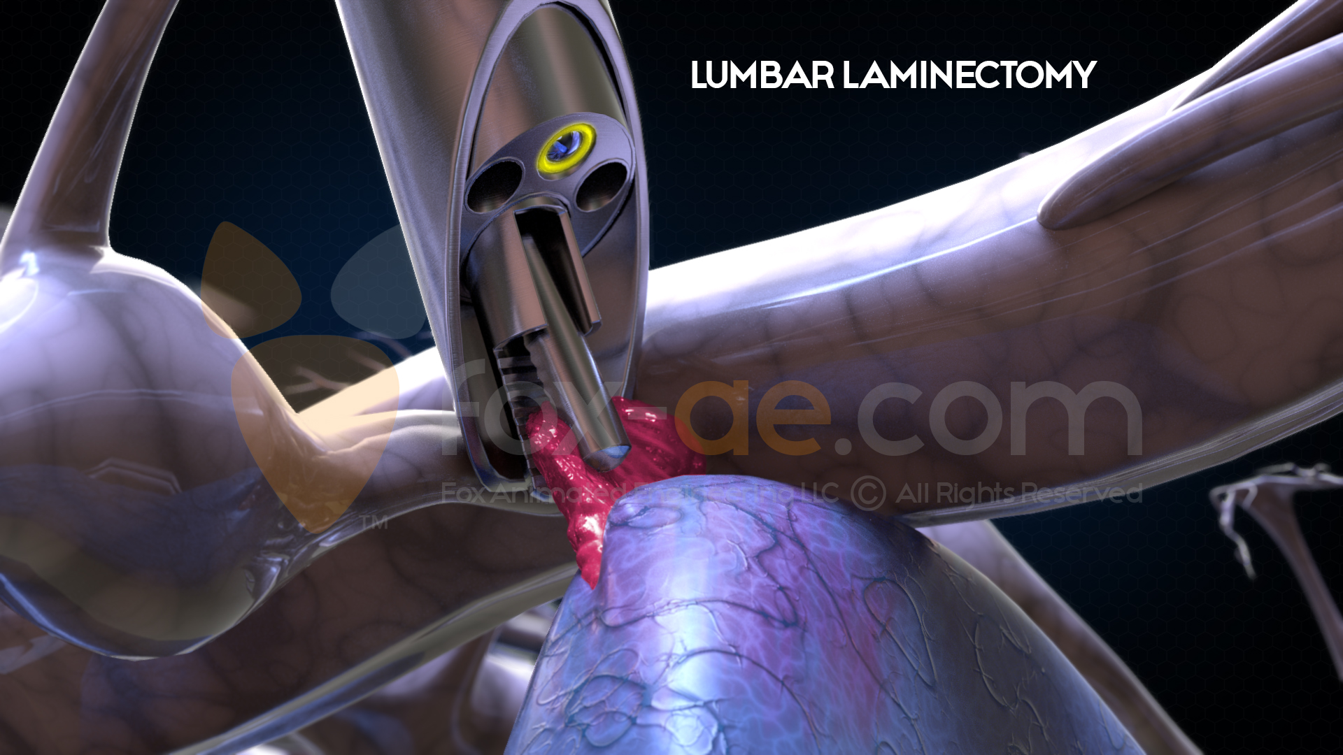 Lumbar-Laminectomy
