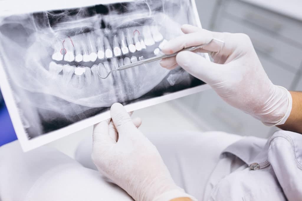 Dental Implant Malpractice