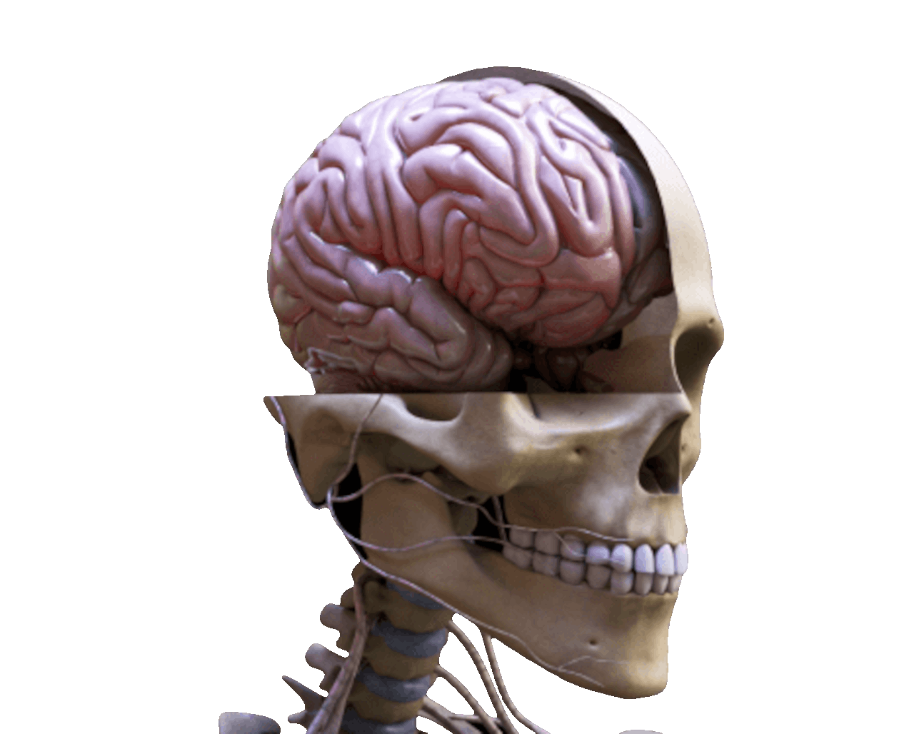 Brain Herniation