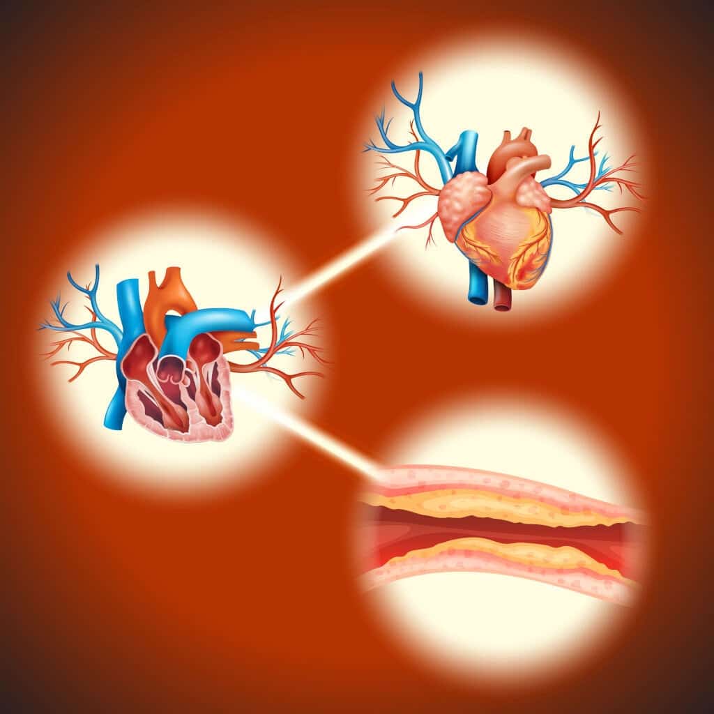 Demonstrating Ischemic Stroke With Medmal Animation
