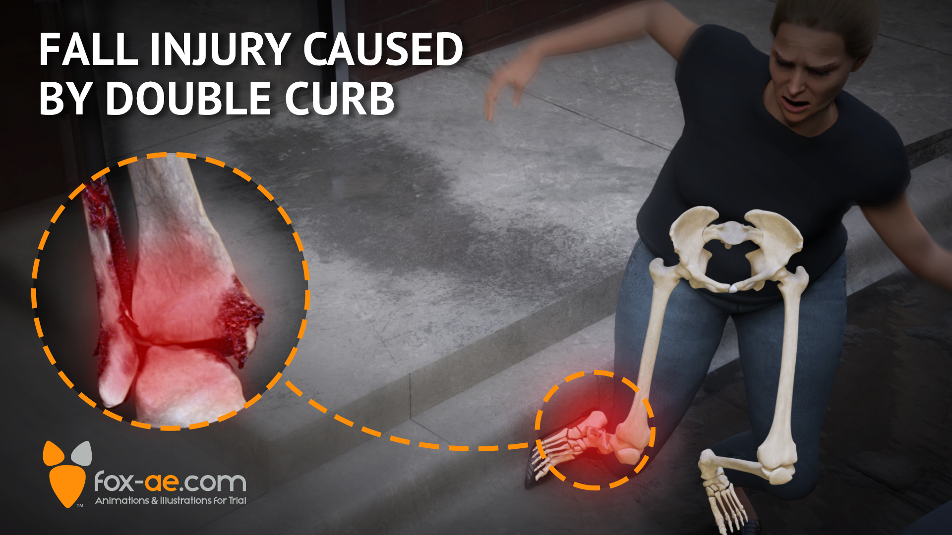 Fall Injury Caused by Double Curb Fox Animated Engineering