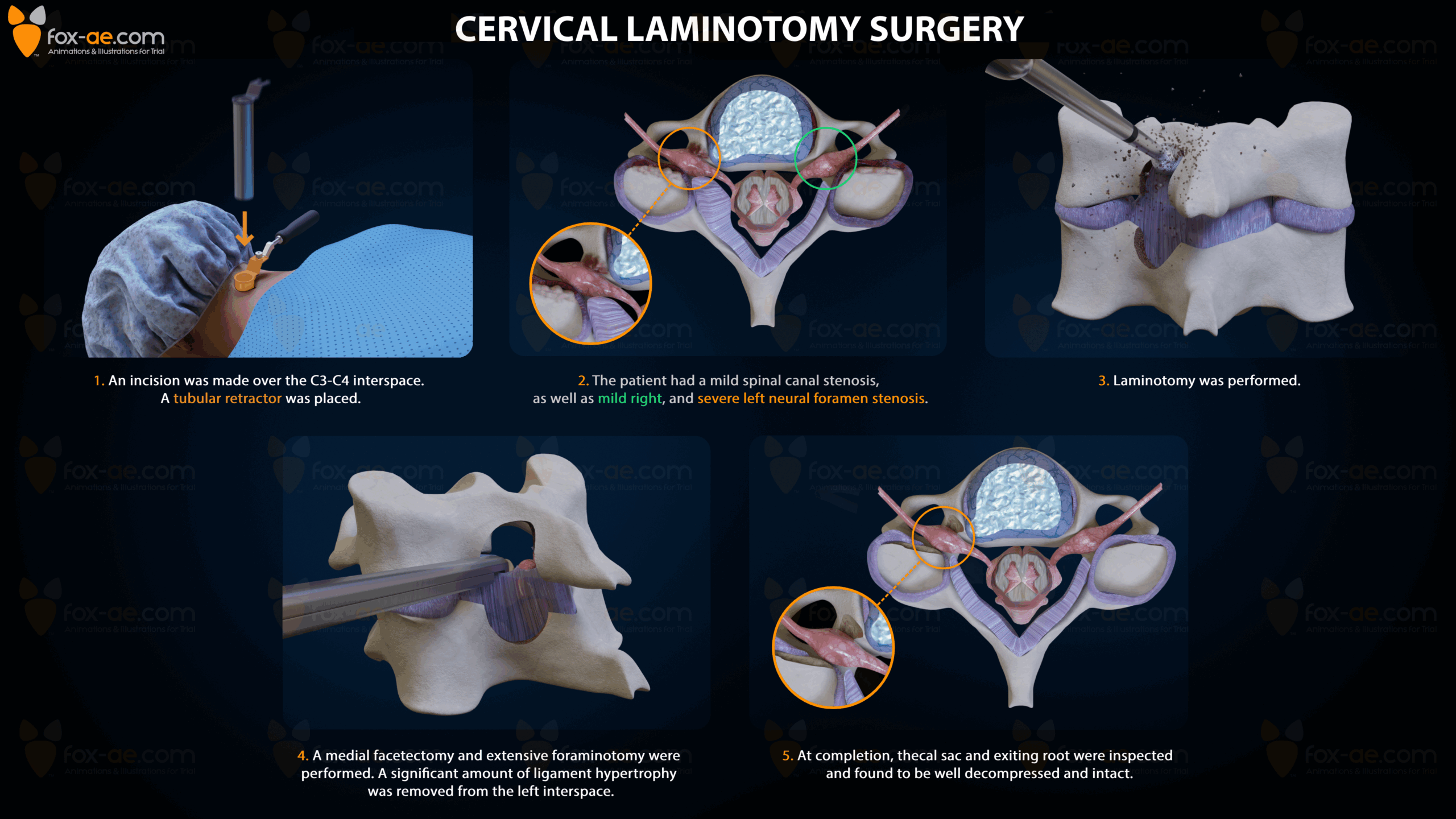Cervical Laminotomy | Fox Animated Engineering