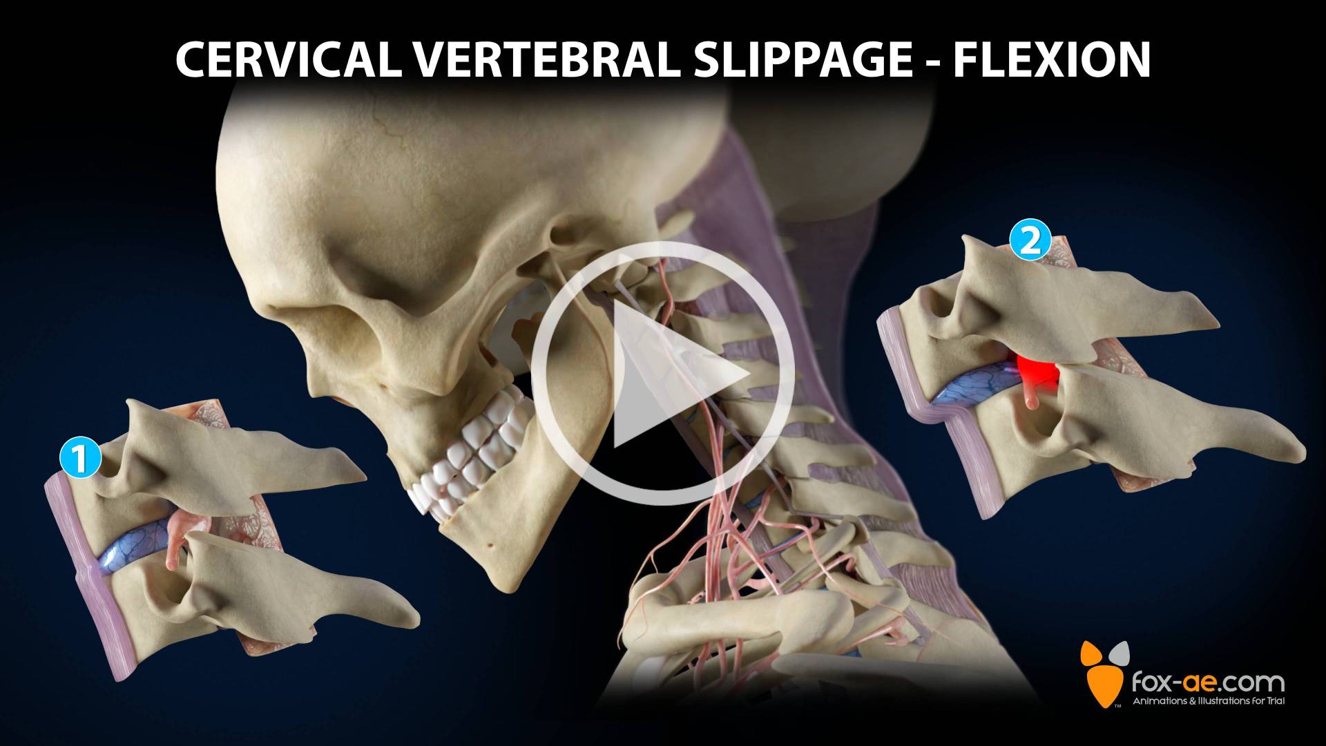 Cervical Vertebral Slippage Flexion | Fox Animated Engineering