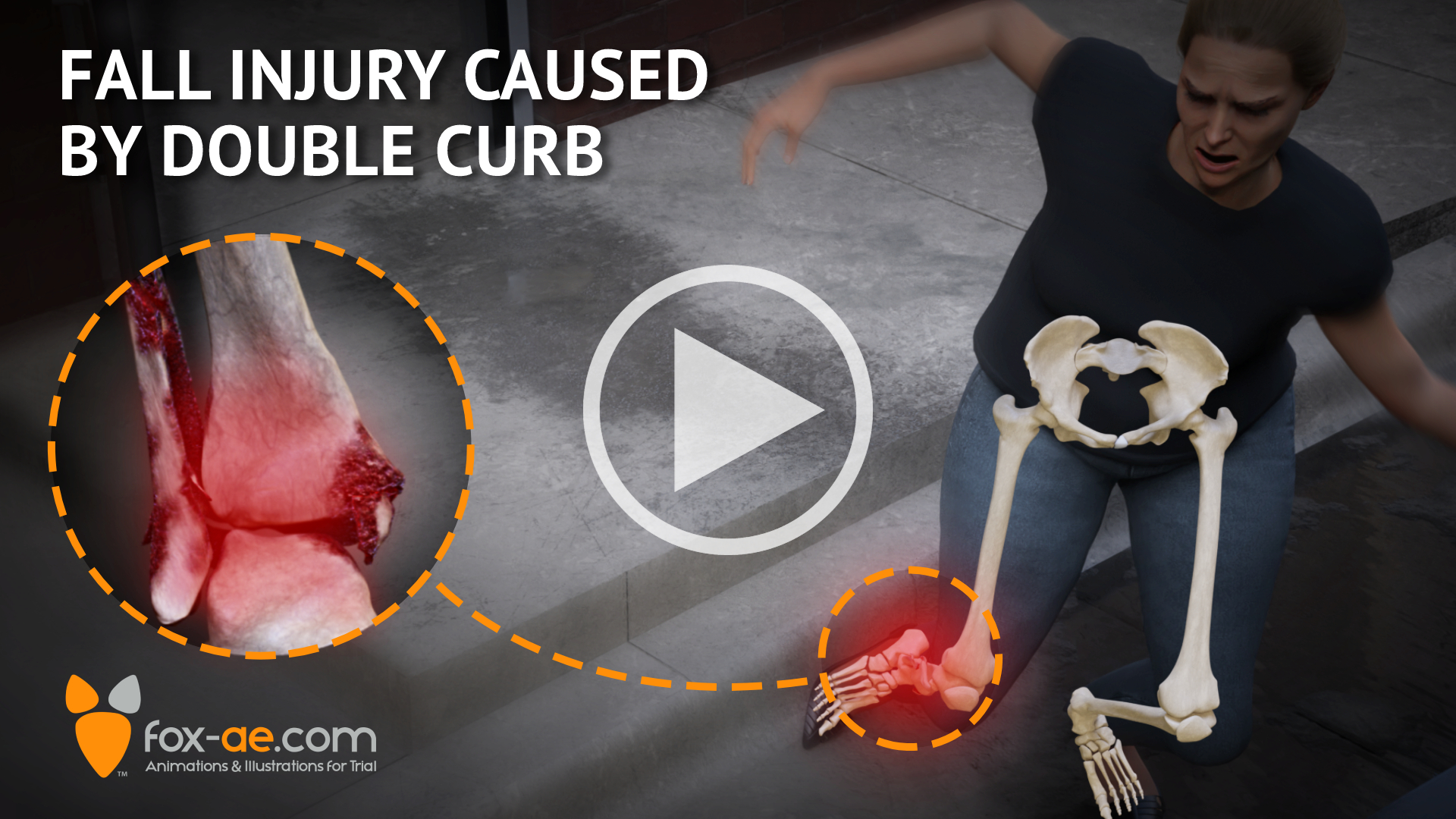 Fall Injury Caused by Double Curb | Fox Animated Engineering