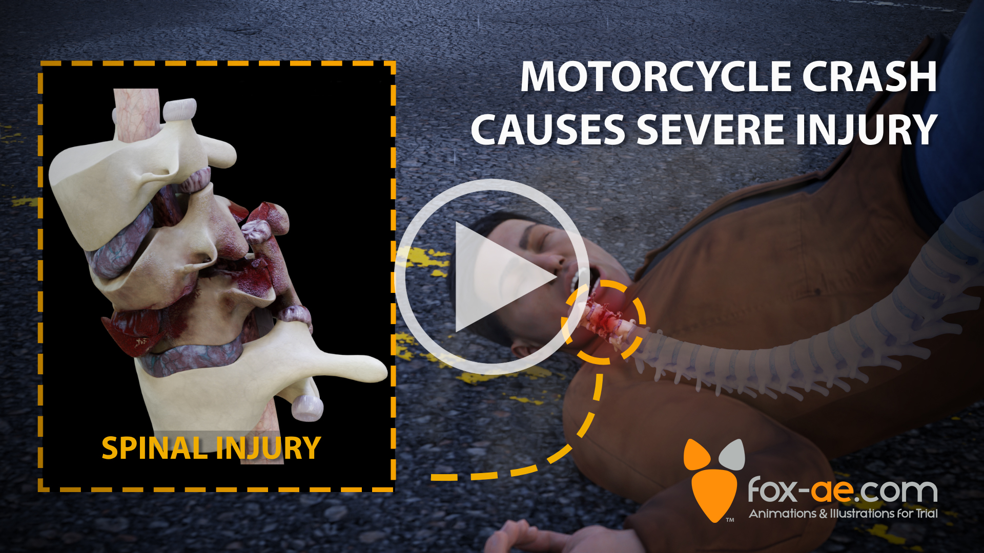 Motorcycle Crash Causes Severe Injury | Fox Animated Engineering