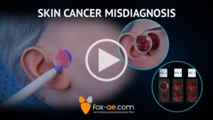 Video thumbnail about skin cancer misdiagnosis: ear with colored marking, biopsy inset images, and Fox-ae branding.